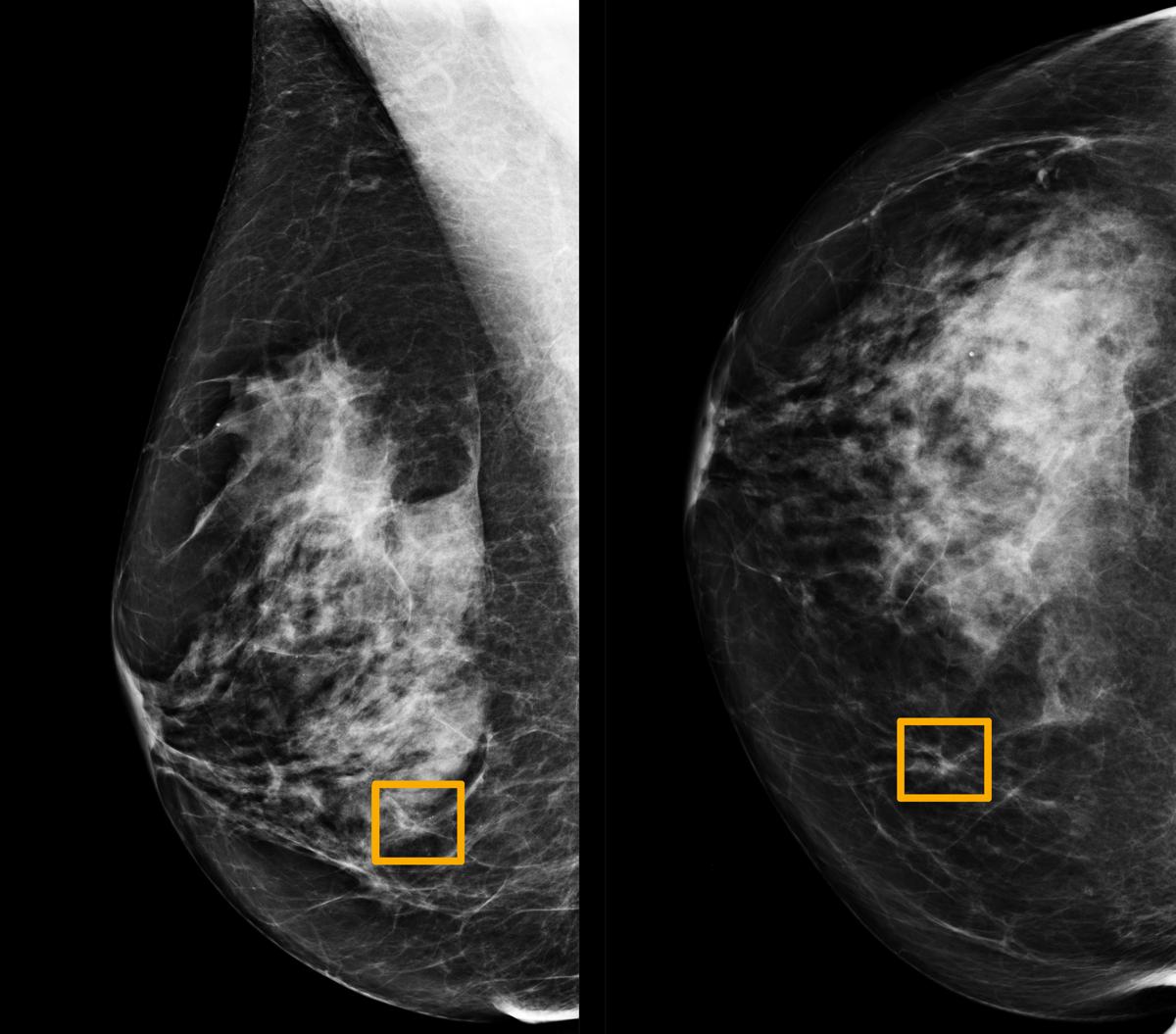 Study finds Google system could improve breast cancer detection